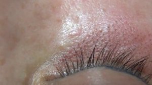 Подтяжка нижних век и коррекция "гусиных лапок" вокруг глаз