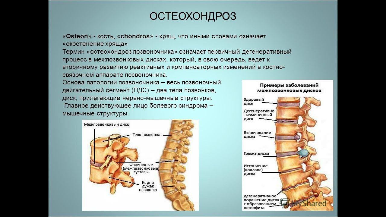 Остеохондроз Урок 5