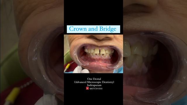 Crown and Bridge For Missing Teeth