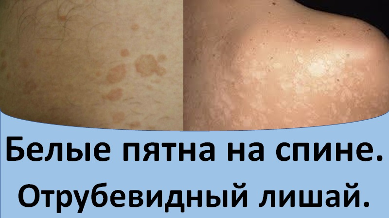 Белые пятна на спине. Отрубевидный лишай.