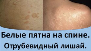 Белые пятна на спине. Отрубевидный лишай.