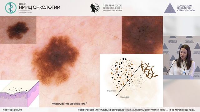Неинвазивная диагностика меланоцитарных опухолей кожи
