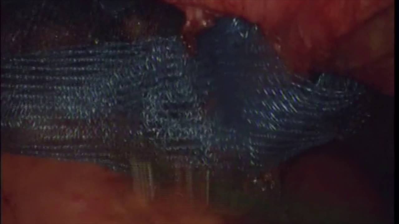 Giant hernia laparoscopic repair смотреть онлайн