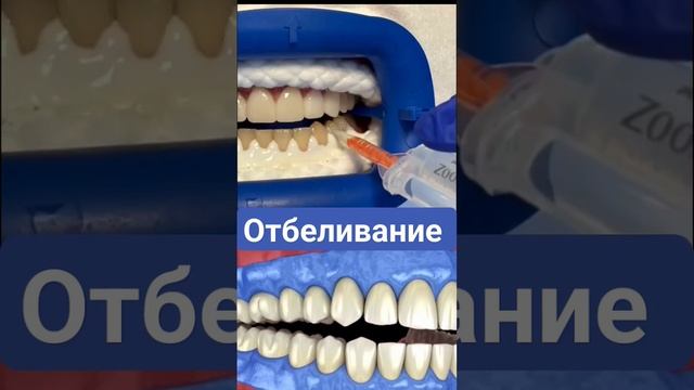 #стоматологияулыбка #краснодар #отбеливаниезубов #zoom #zoom4 (720p).mp4