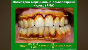 1. Оценка состояния тканей пародонта. Пародонтальные индексы: PMA, GI, SBI, CPITN, CPI