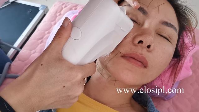 4D HIFU смотреть онлайн