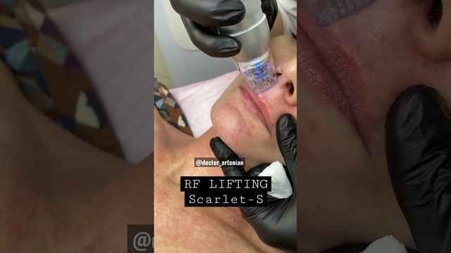 Rf lifting  #scarlet #antiaging #acne #youtube #botox #laser #clinic #НазелиАртенян #NazeliArtenian