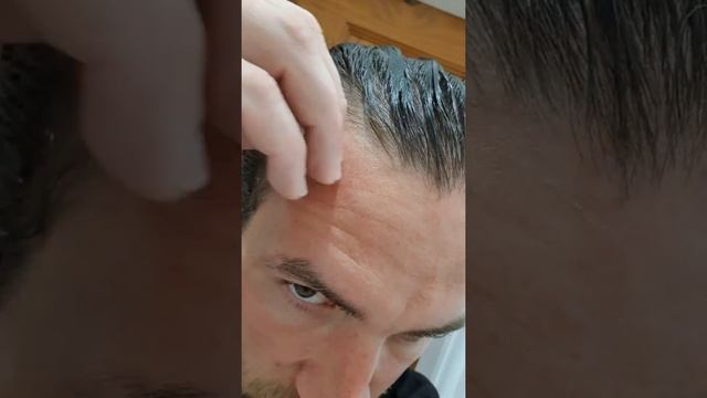 Finasteride 4 Month Results #finasteride #hairloss #hair #subscribe смотреть онлайн