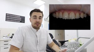 ВИНИРЫ после ОРТОДОНТИИ. Разбор клинического случая