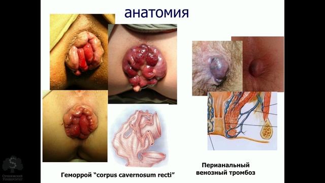 Геморрой. Электив 