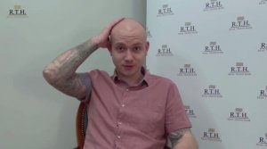 Двухдневная сессия: 3500 графтов.