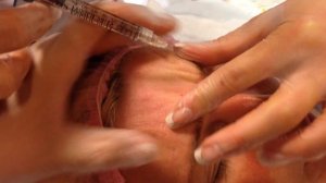 АирисКом: филлеры  практика ученик морщины межбровья