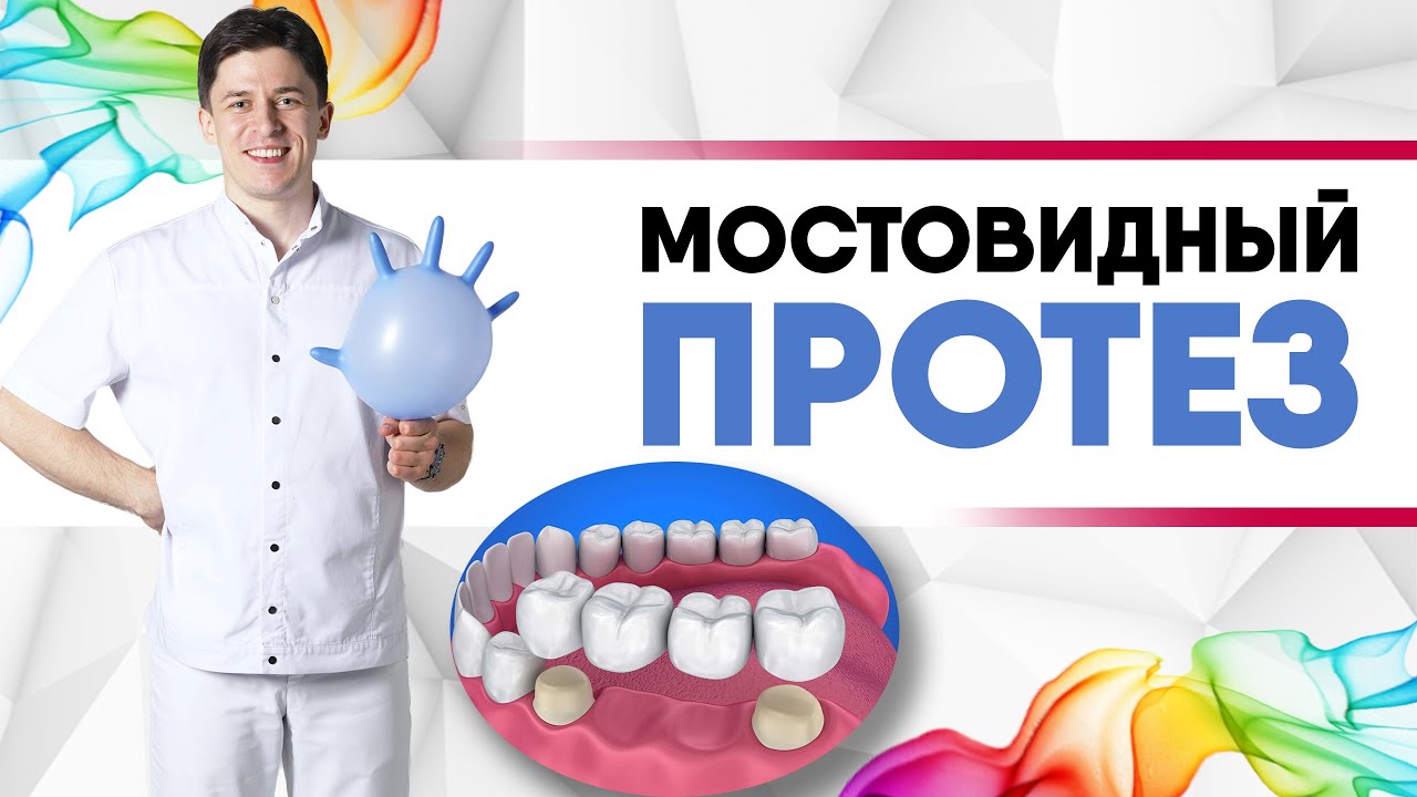 Мостовидные протезы на зубах [ зубной мост, мостовидный протез ]. |Металлокерамика vs цирконий|.