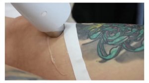 Татуировки при LaserEpil