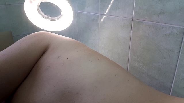 Кератома на теле. Удаление