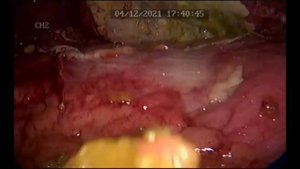 Прикрытая прободная язва