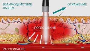 Лазер высокой интенсивности BTL-6000 HIL. Особенности технологии и медицинские эффекты.