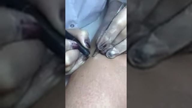 Электроэпиляция смотреть онлайн