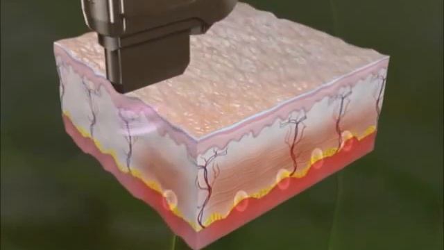 ULTRAFORMER (HIFU, High-Intensity Focused Ultrasound) Lifting machine | Skinnovation Clinics