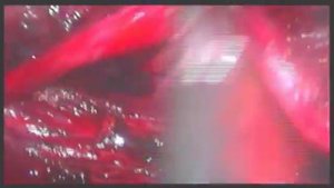 пластика мочеточника