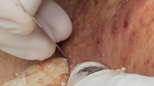 Best Pimple Popping P3 | Mụn Dậy Thì Siêu Hấp Dẫn P3 - SacDepSpa#183