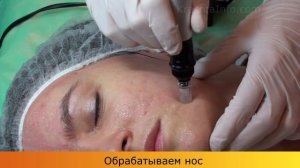 Дермаштамп профессионалам