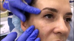 Коррекция скул филлером