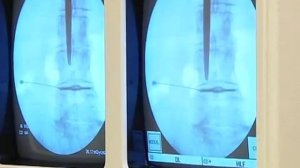 Удаление межпозвоночной грыжти лазером