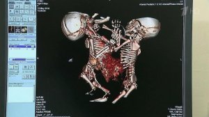 В Москве успешно завершена сложнейшая операция по разделению сиамских близнецов