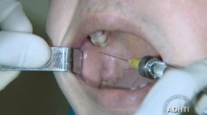 торусальная анестезия...torusal anesthesia