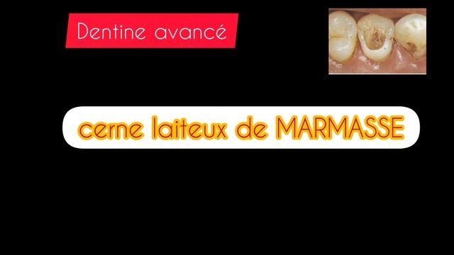 examen clinique d'une dentinite avancée et diagnostic différentiel смотреть онлайн