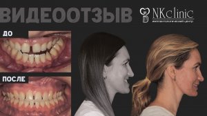 Ортогнатическое лечение большой нижней челюсти (перекрёстного мезиального прикуса)