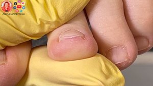 Педикюр вросшие ногти / Врастают ногти на ногах
