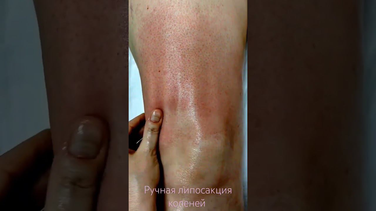 ручная липосакция массаж коленей #массаж #похудение #shortvideo #здоровье #shorts  #липосакция