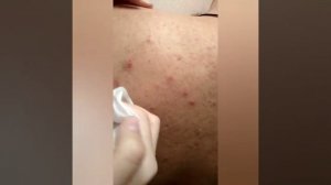 Прыщики