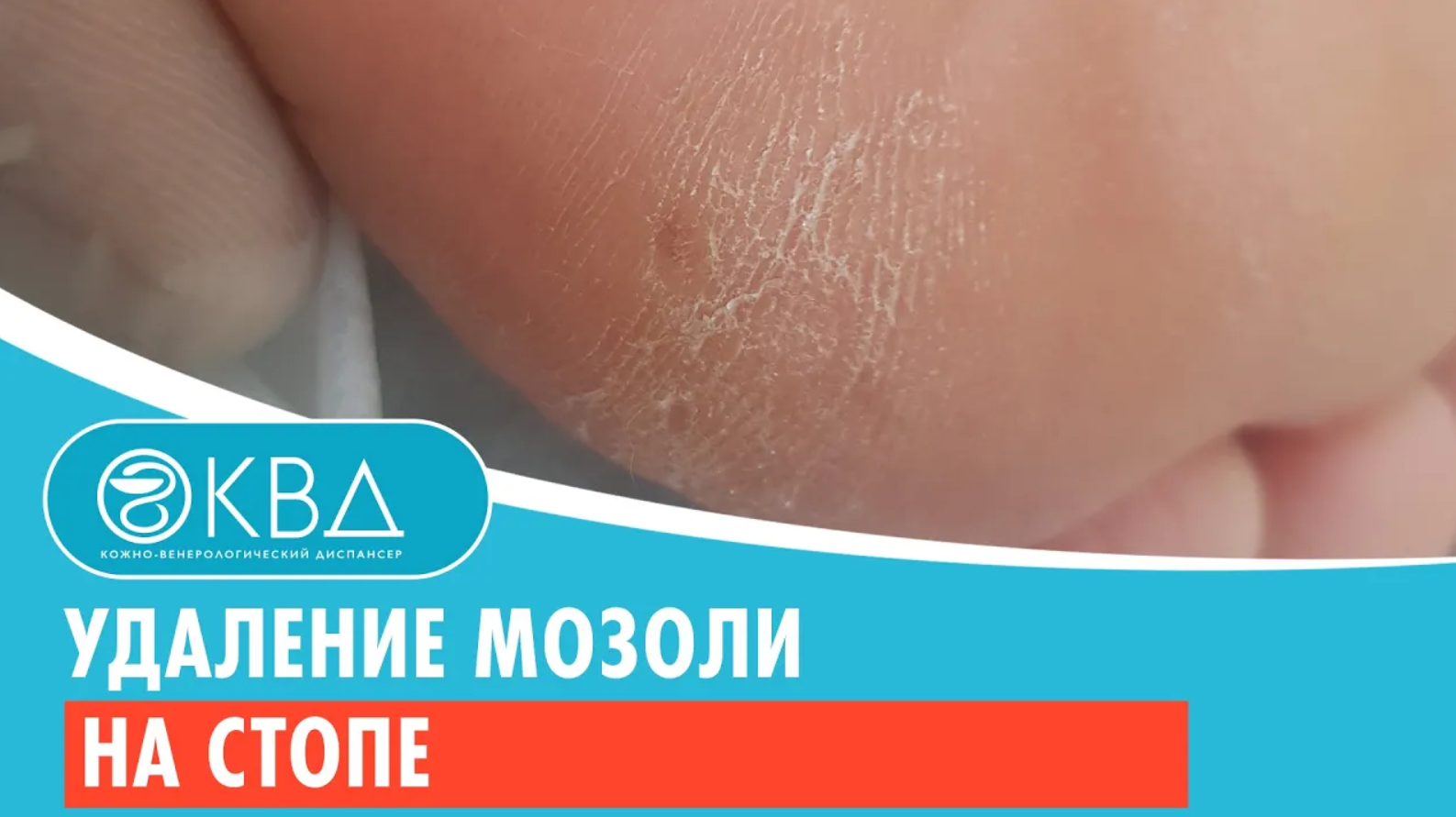 ✅ Удаление мозоли на стопе. Клинический случай №929