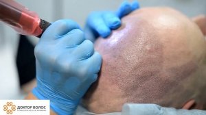 Трихопигментация