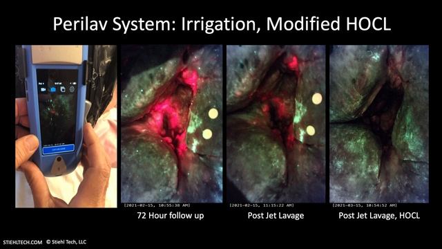 LIGHT IT UP! Using Fluorescence Imaging to Guide Wound Treatments смотреть онлайн