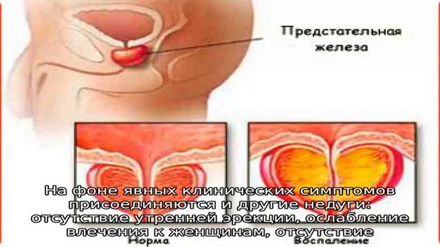 Острый простатит: причины возникновения и прогноз излечения