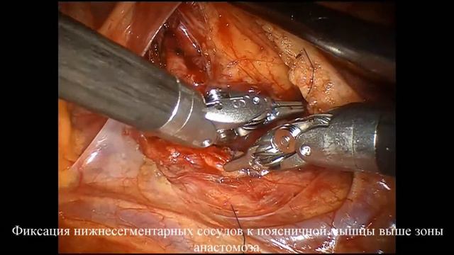 Робот-ассистированная пластика лоханочно мочеточникового сегмента при гидронефрозе смотреть онлайн