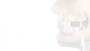 Атрофия костной ткани челюсти. Атрофия кости после удаления зуба. Стоматология ROOTT.mp4