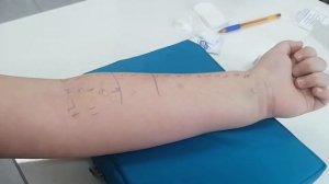 Как делают аллергопробы на коже у детей