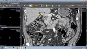 КТ АНГИОГРАФИЯ .