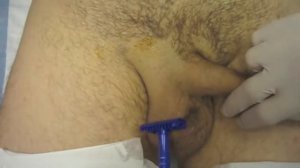 Scrotal Shaving Technique