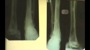 Лечение хронического бронхита