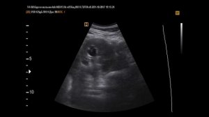 Стент мочеточниковый на УЗИ мочевого пузыря и почек (21-10-17)