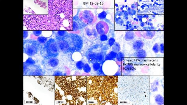 Lymphoplasmacytic Neoplasms: Cases and Differentials смотреть онлайн