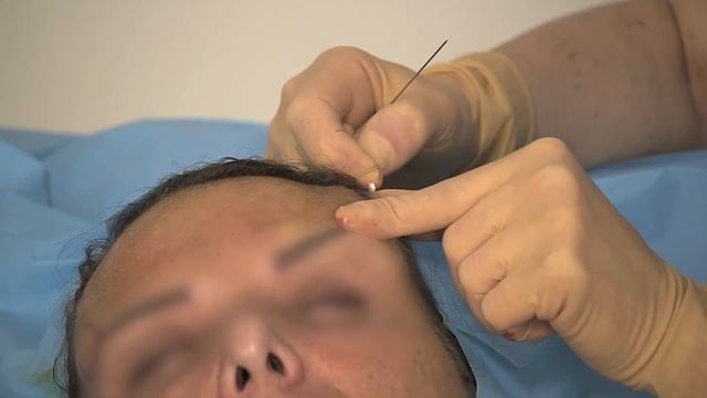 LIFTING SANS CHIRURGIE / Ouvrir le regard : pose des fils tenseurs résorbables Aptos