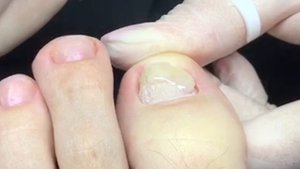 Протезирование ногтя