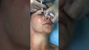 5 точек. Протокол для PDRN Booster